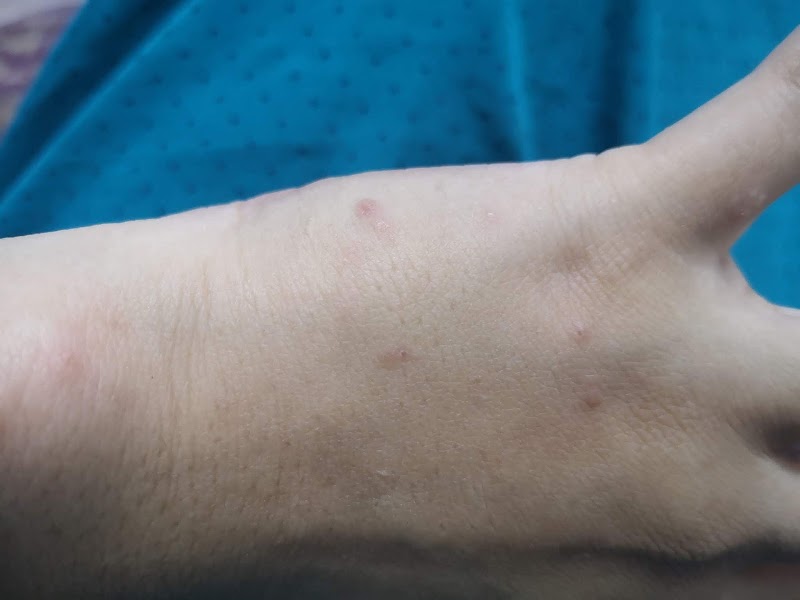 Naik Biji Biji Halus dan Gatal di Tangan